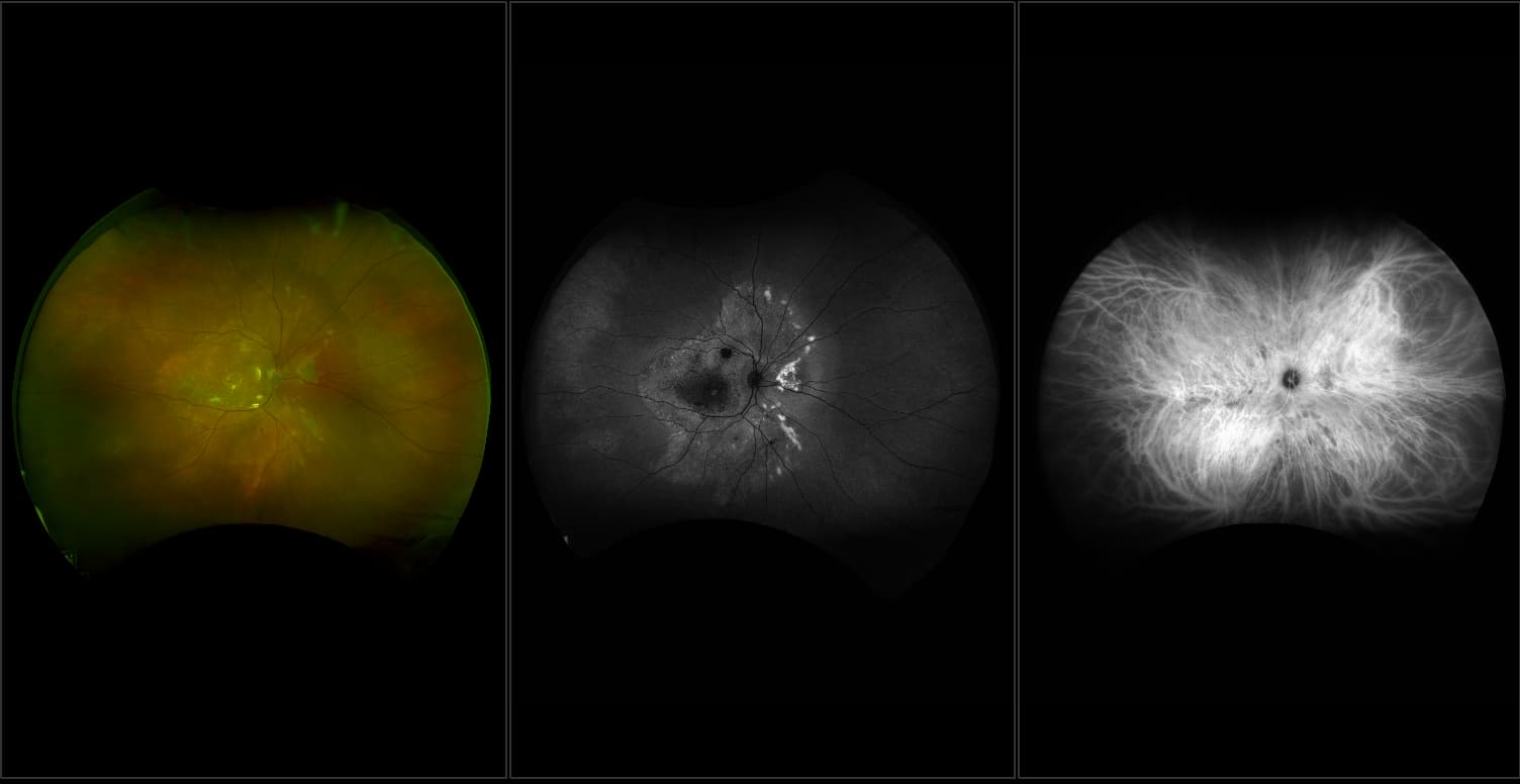Silverstone - Best's Disease with Hereditary Retinal Dystrophy, RG, AF, ICG